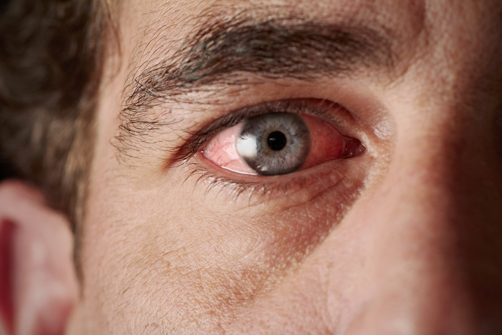 The eyes of a drunk man are bloodshot